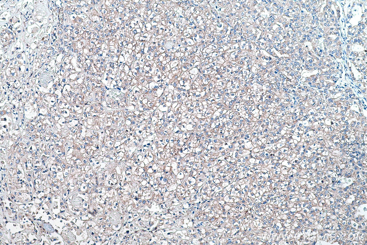 Immunohistochemistry (IHC) staining of human endometrial cancer tissue using HPRT1 Monoclonal antibody (67518-1-Ig)