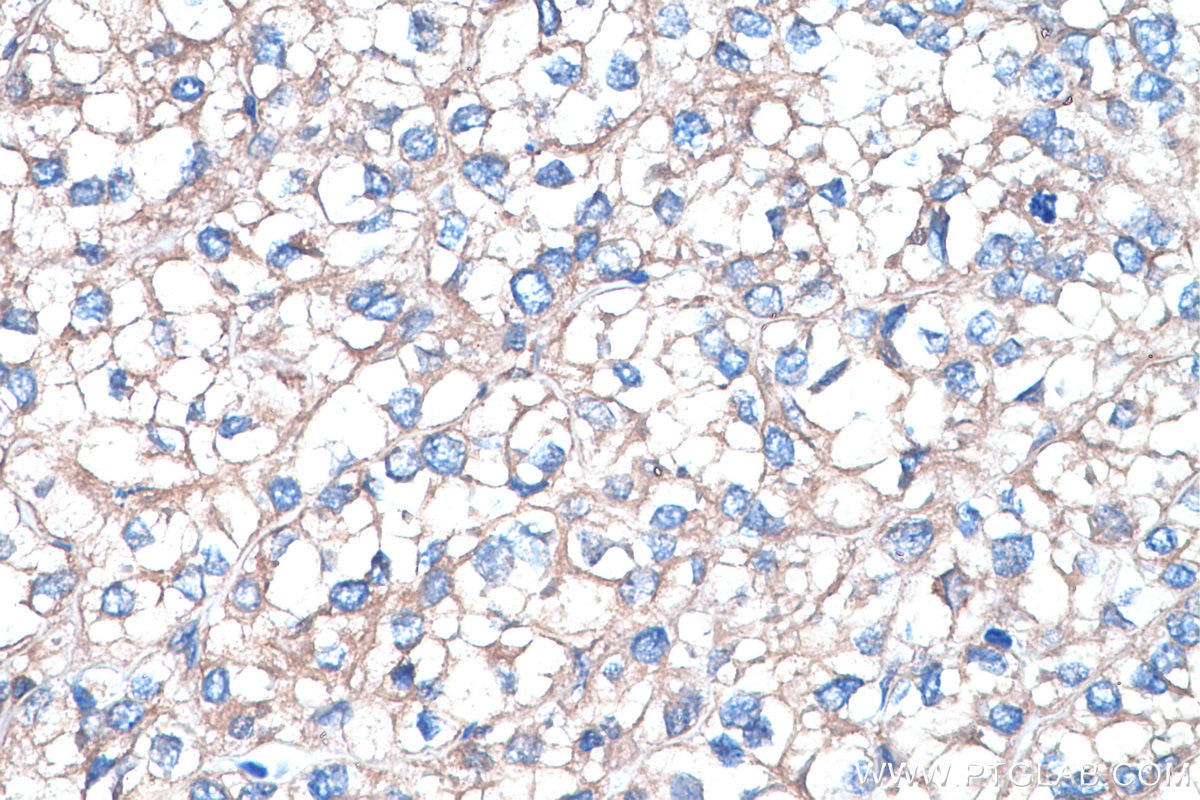 Immunohistochemistry (IHC) staining of human endometrial cancer tissue using HPRT1 Monoclonal antibody (67518-1-Ig)