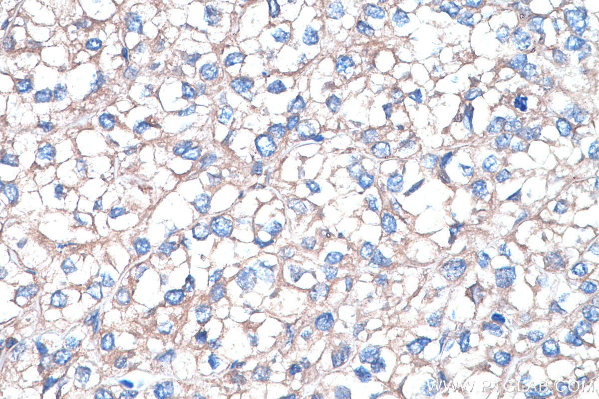 IHC staining of human endometrial cancer using 67518-1-Ig