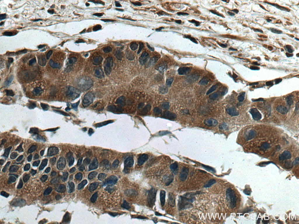 Immunohistochemistry (IHC) staining of human colon cancer tissue using HPS3 Polyclonal antibody (10768-1-AP)