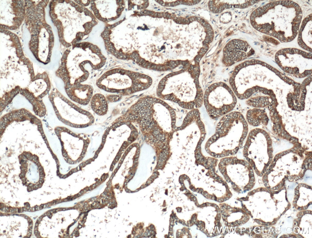 IHC staining of human ovary tumor using 11371-1-AP