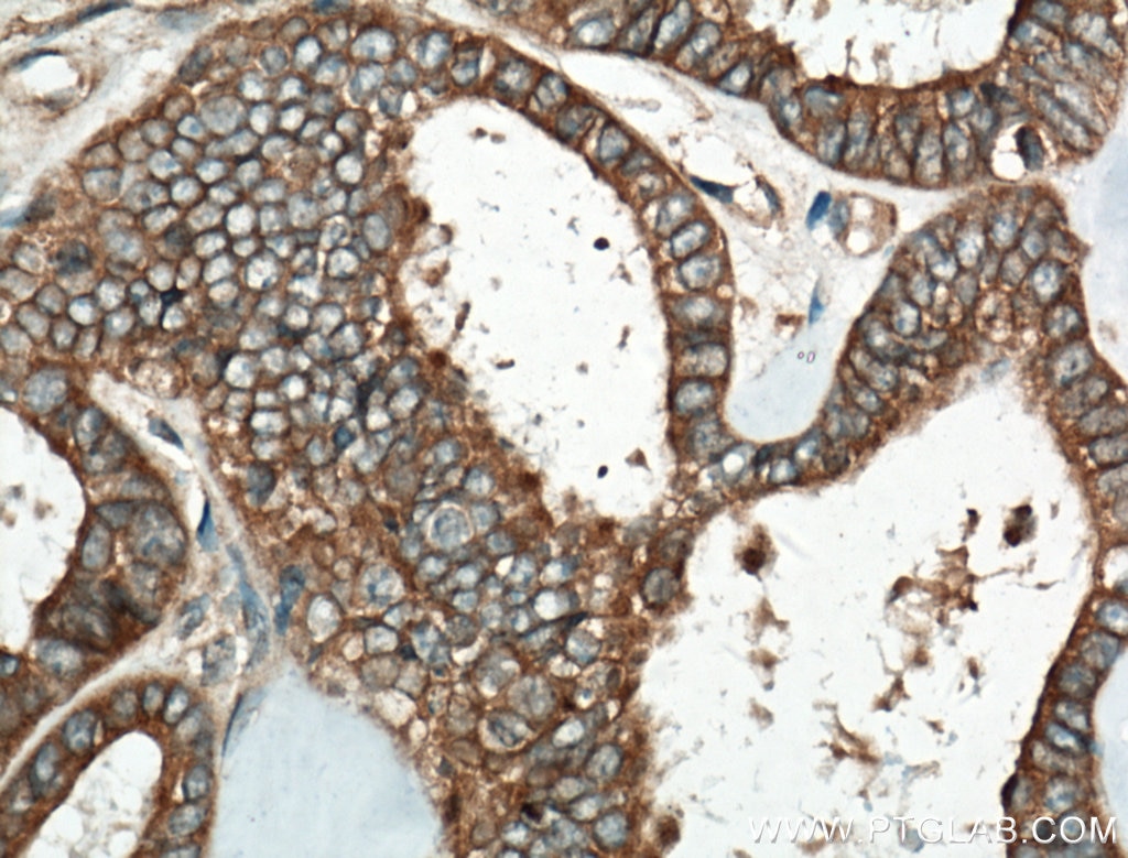 Immunohistochemistry (IHC) staining of human ovary tumor tissue using HPS6 Polyclonal antibody (11371-1-AP)