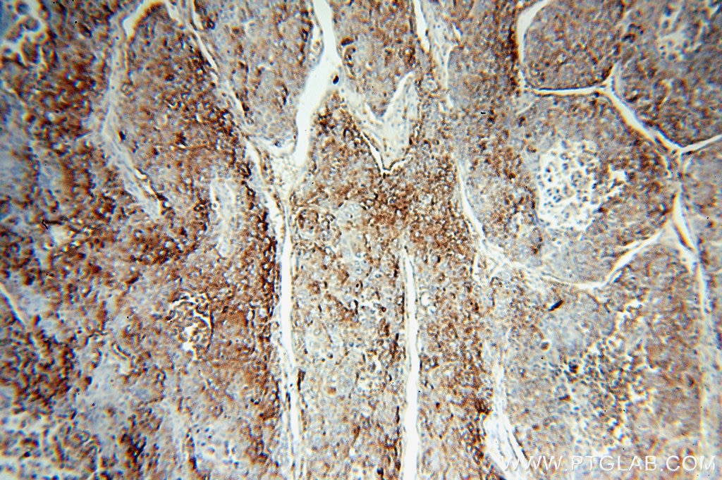 Immunohistochemistry (IHC) staining of human liver cancer tissue using HPSE Polyclonal antibody (16673-1-AP)