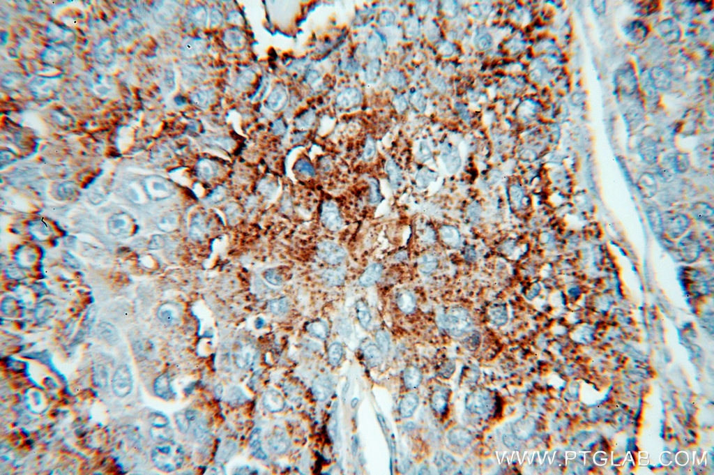 Immunohistochemistry (IHC) staining of human liver cancer tissue using HPSE Polyclonal antibody (16673-1-AP)