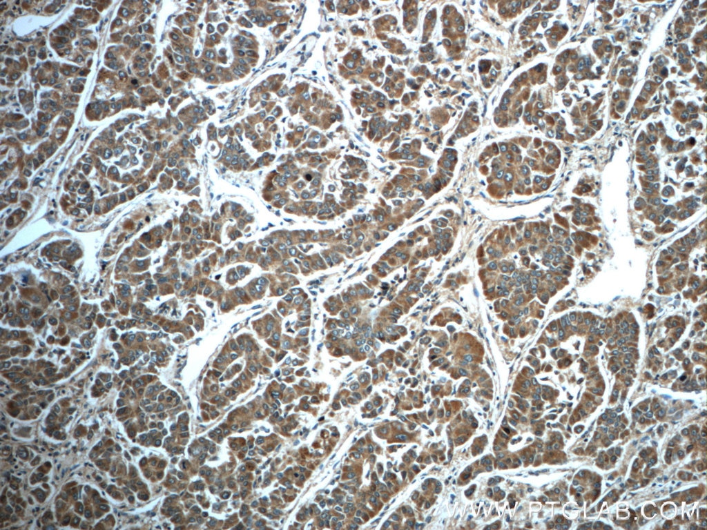 Immunohistochemistry (IHC) staining of human liver cancer tissue using HPSE Polyclonal antibody (24529-1-AP)