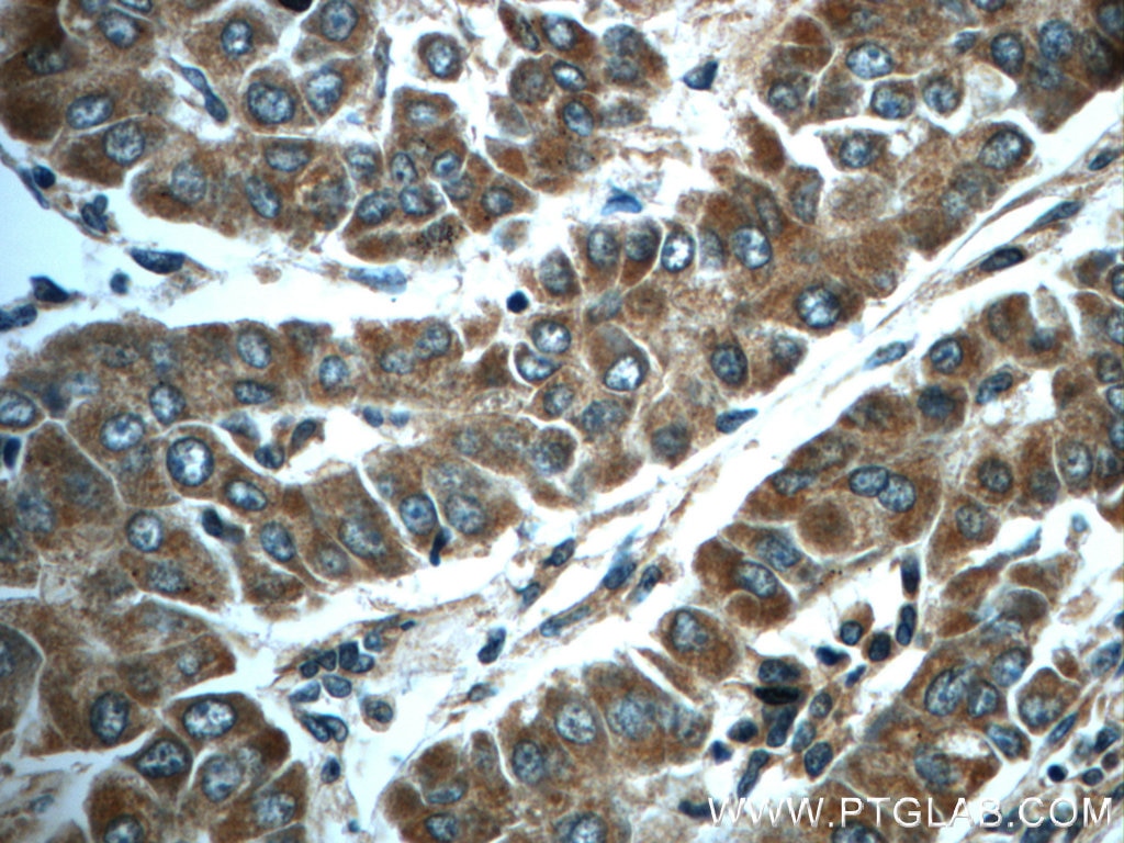 Immunohistochemistry (IHC) staining of human liver cancer tissue using HPSE Polyclonal antibody (24529-1-AP)