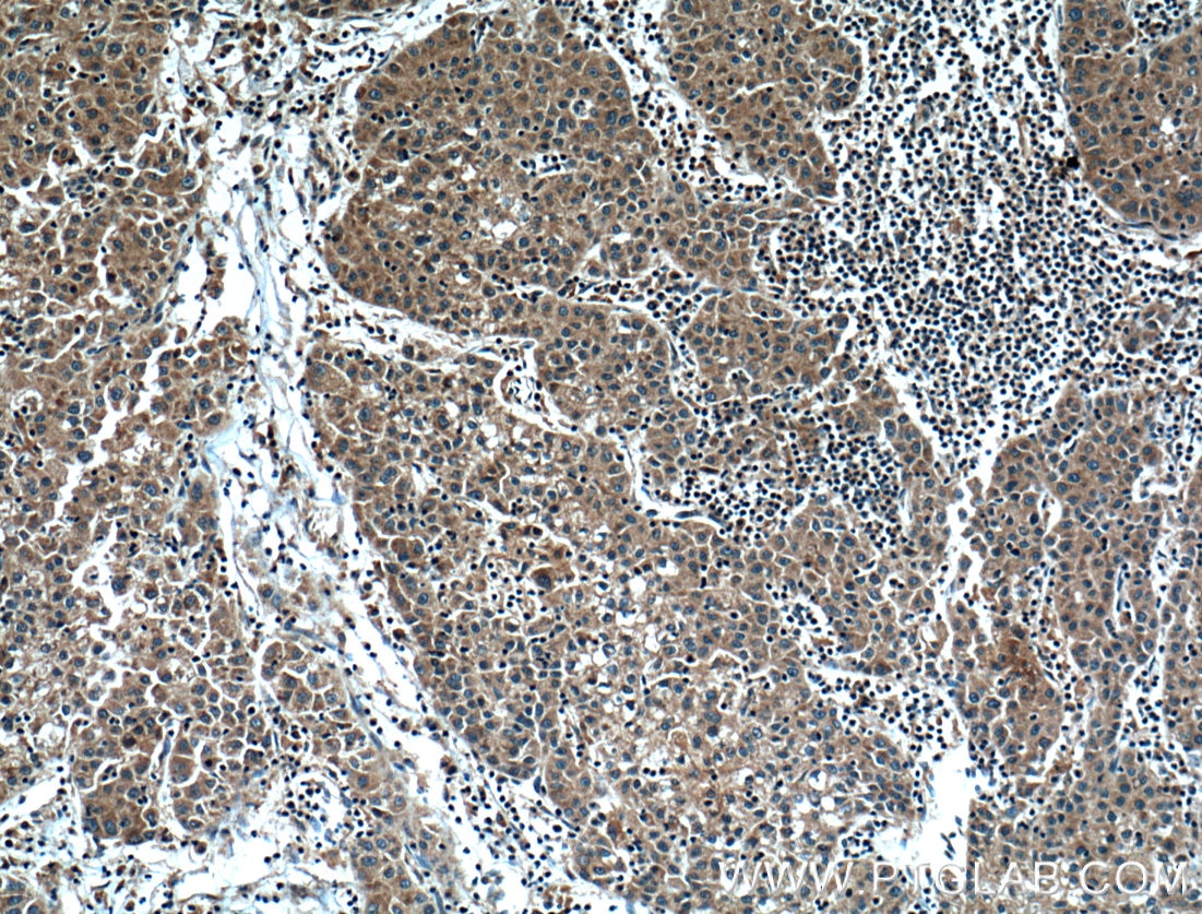 Immunohistochemistry (IHC) staining of human liver cancer tissue using HPSE Monoclonal antibody (66226-1-Ig)