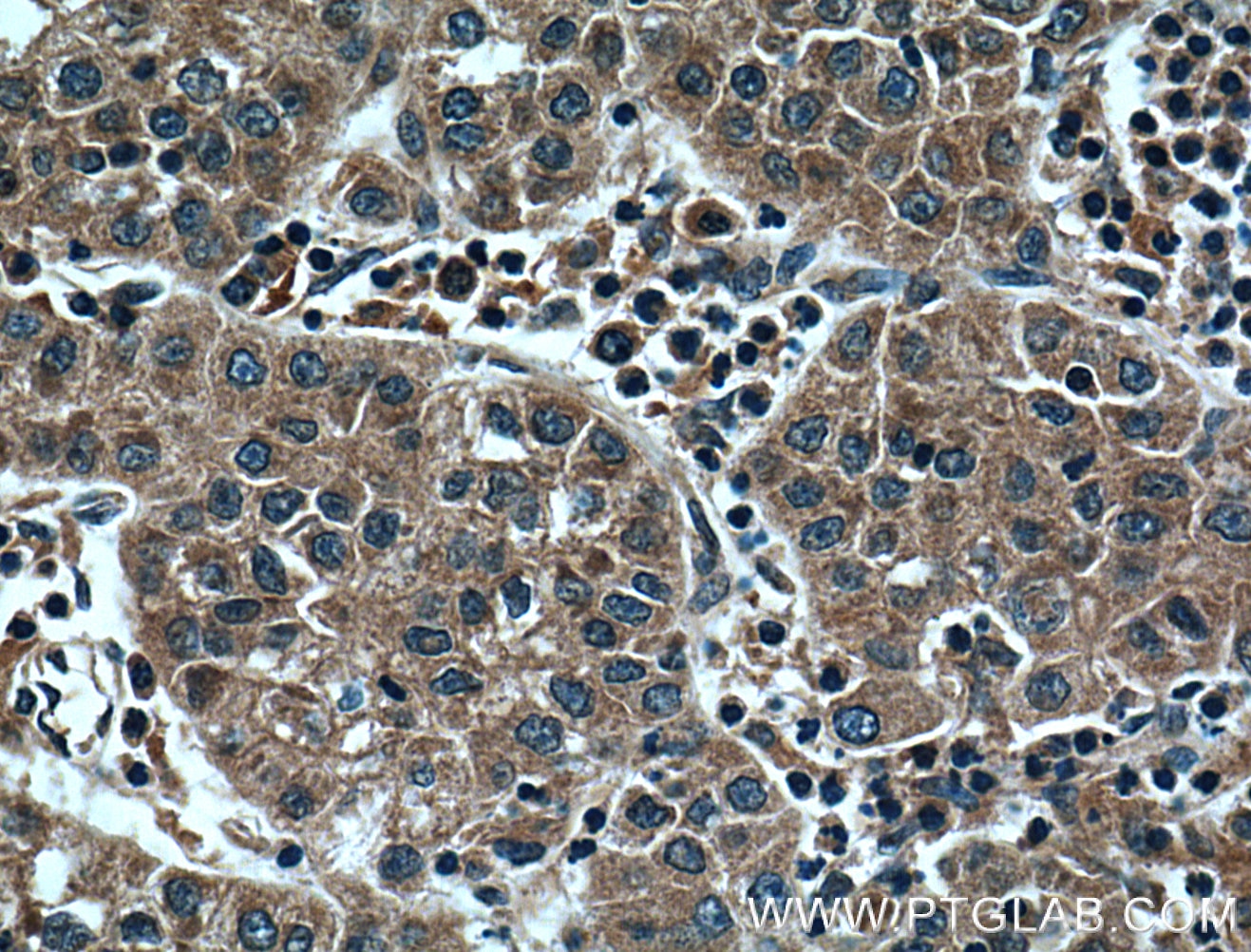 Immunohistochemistry (IHC) staining of human liver cancer tissue using HPSE Monoclonal antibody (66226-1-Ig)