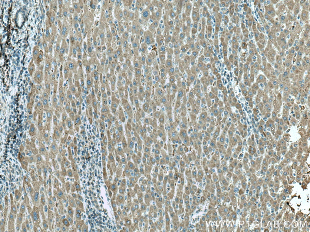 Immunohistochemistry (IHC) staining of human liver cancer tissue using HRD1/SYVN1 Monoclonal antibody (67488-1-Ig)