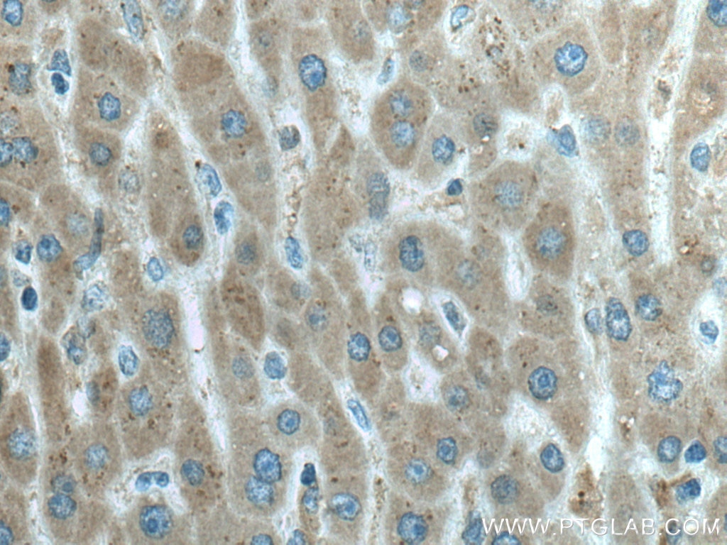 Immunohistochemistry (IHC) staining of human liver cancer tissue using HRD1/SYVN1 Monoclonal antibody (67488-1-Ig)