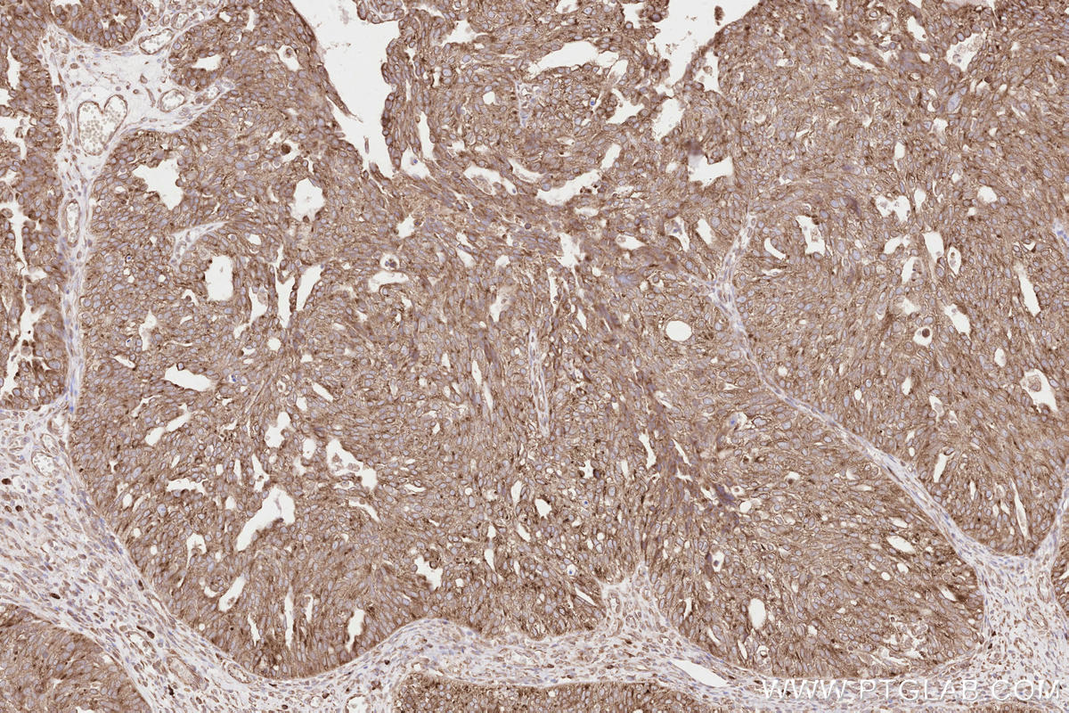 IHC staining of human ovary cancer using 67488-1-Ig Immunohistochemistry (IHC) staining of human ovary cancer tissue using HRD1/SYVN1 Monoclonal antibody (67488-1-Ig)