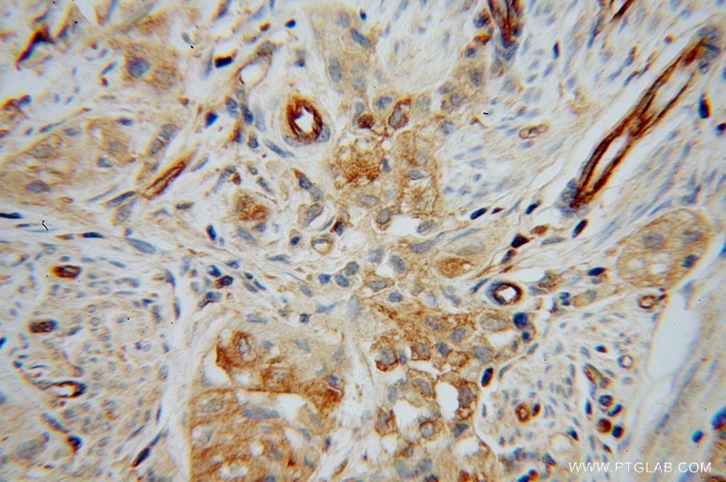 Immunohistochemistry (IHC) staining of human endometrial cancer tissue using HRH1 Polyclonal antibody (13413-1-AP)