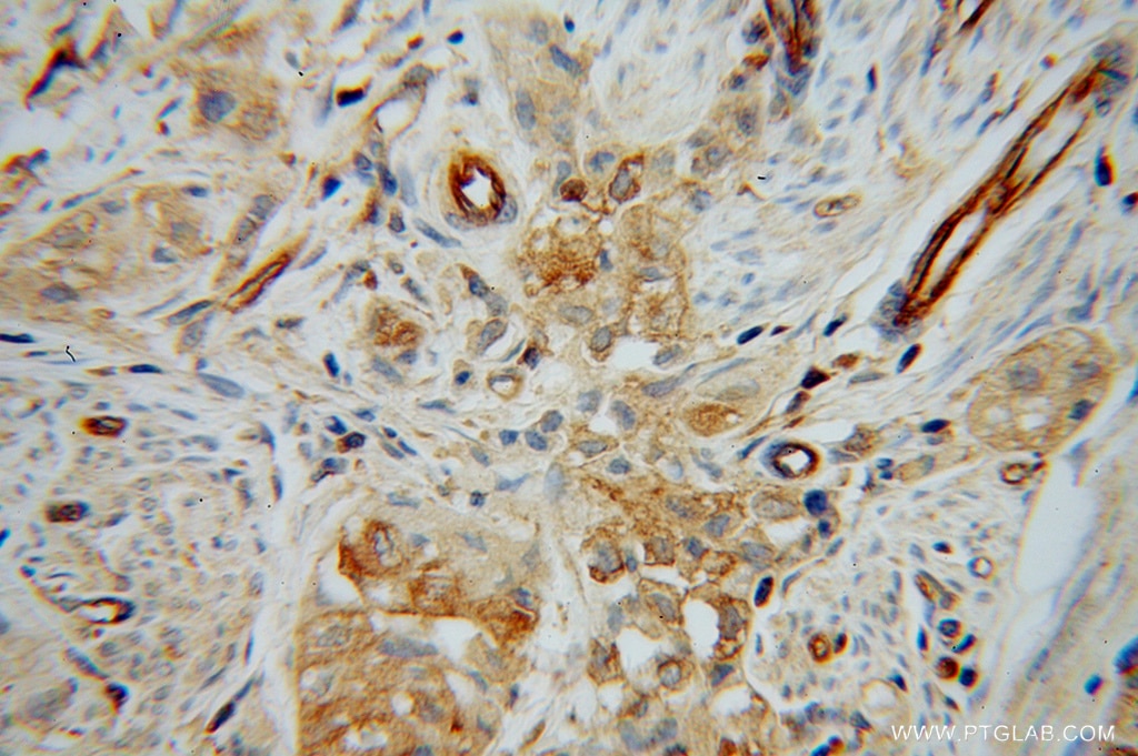 IHC staining of human endometrial cancer using 13413-1-AP