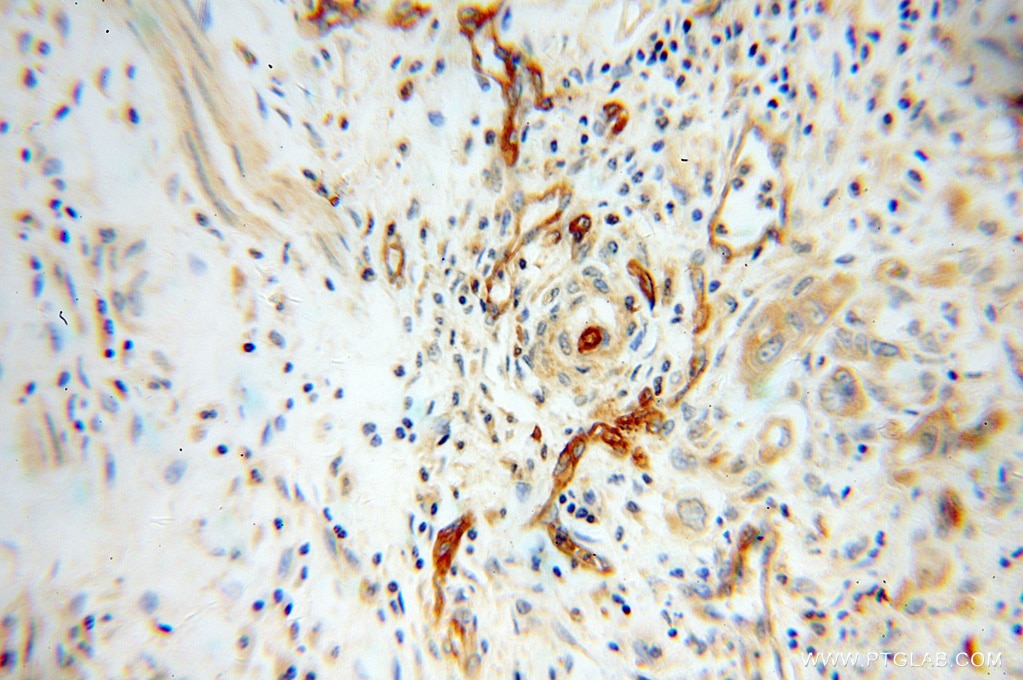 Immunohistochemistry (IHC) staining of human colon cancer tissue using HRH1 Polyclonal antibody (13413-1-AP)