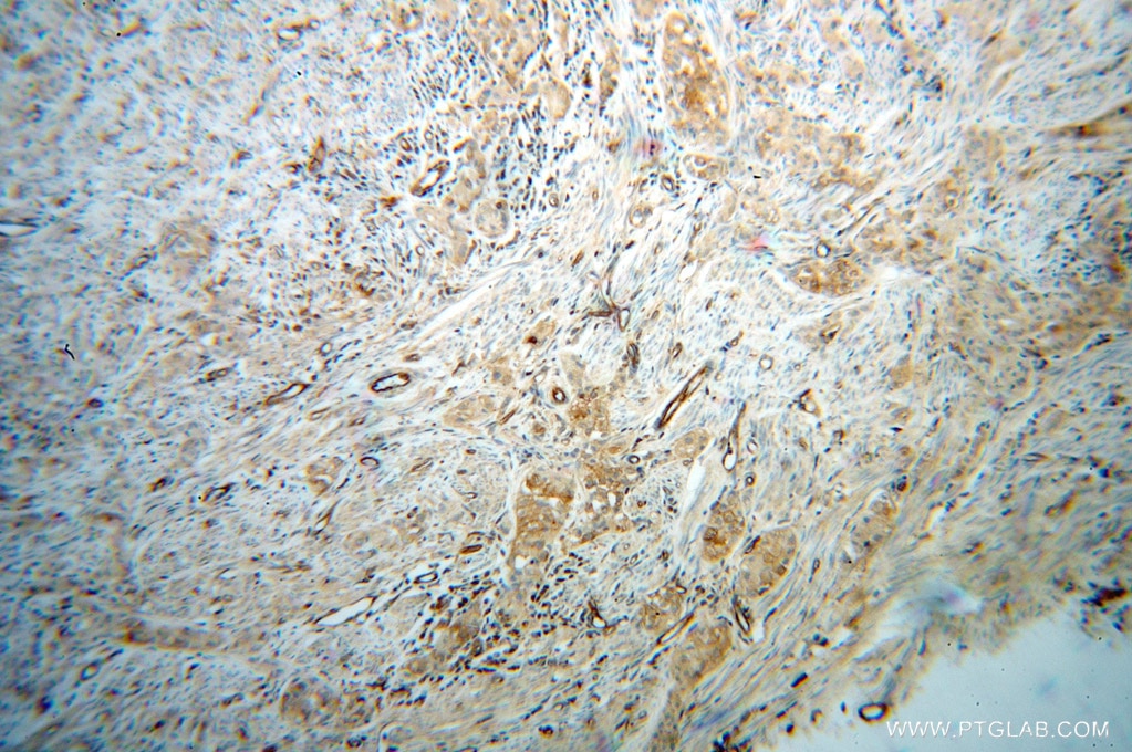 IHC staining of human endometrial cancer using 13413-1-AP