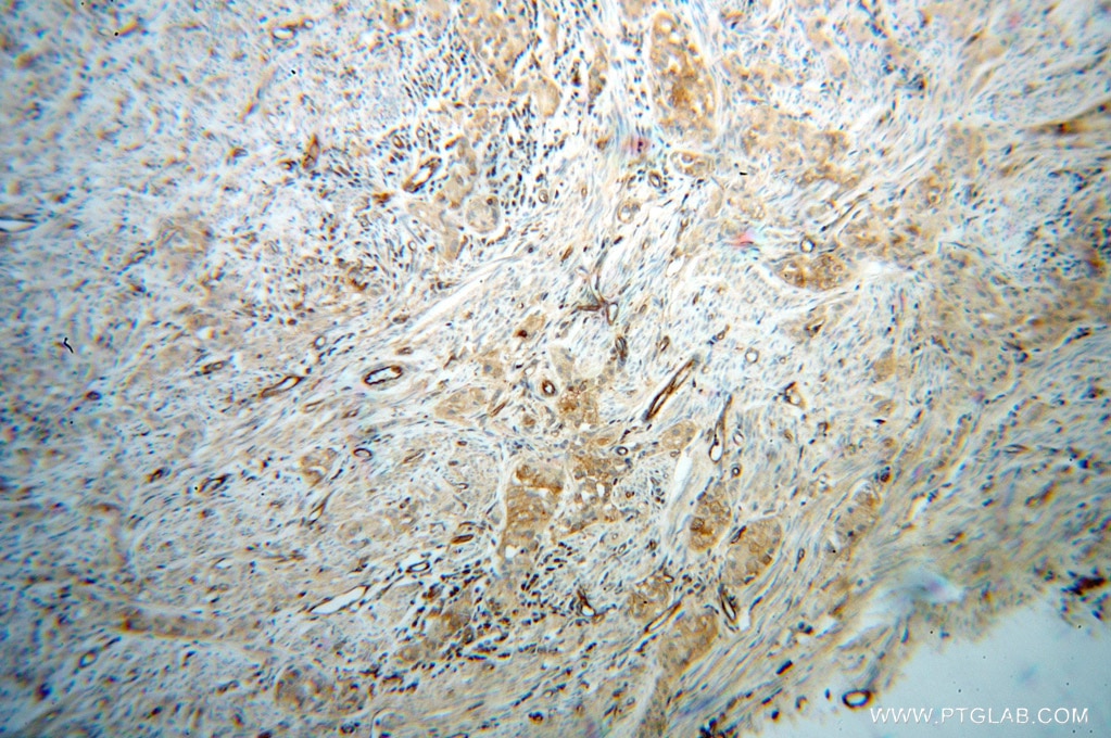 Immunohistochemistry (IHC) staining of human endometrial cancer tissue using HRH1 Polyclonal antibody (13413-1-AP)