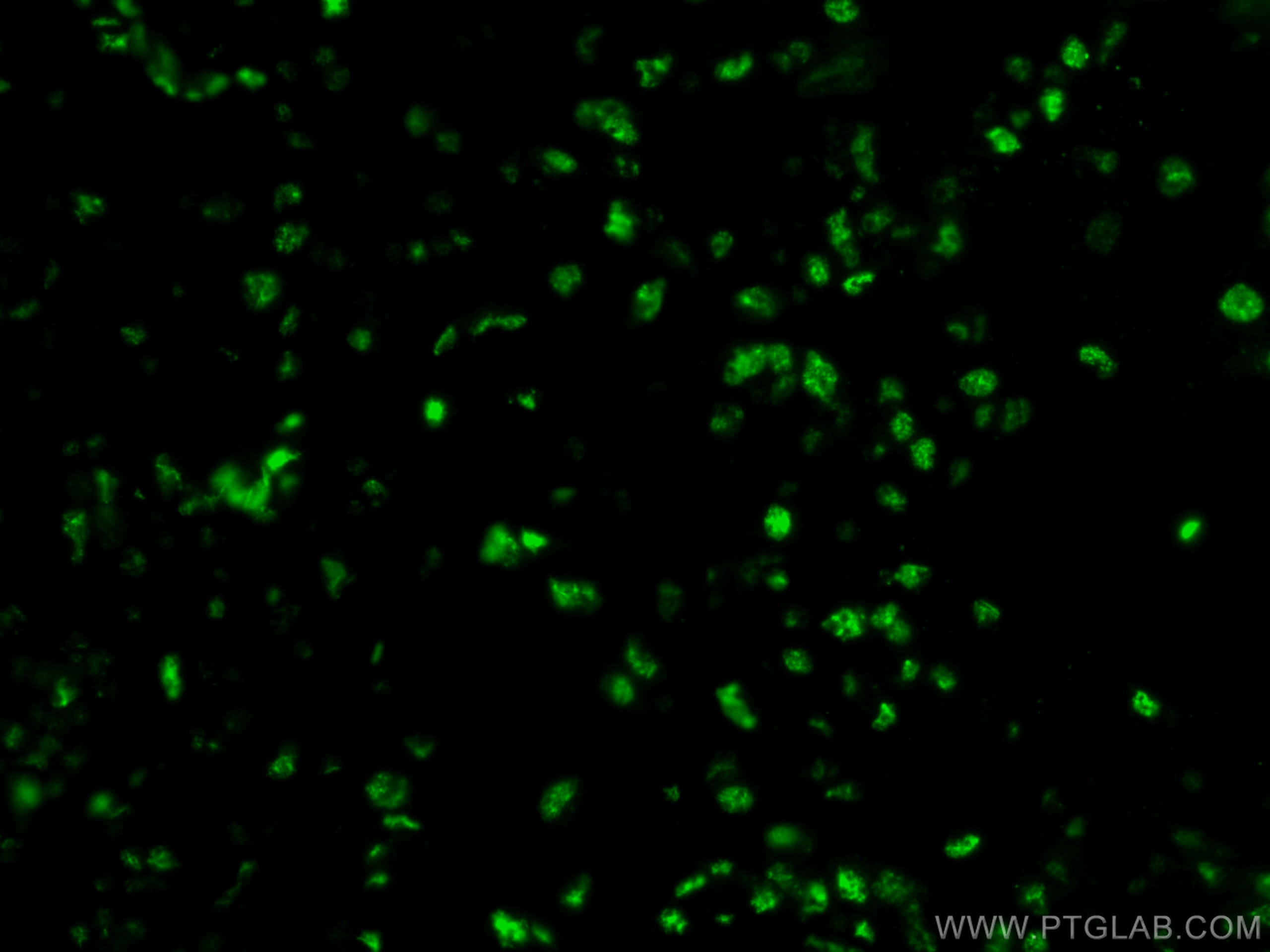 Immunofluorescence (IF) / fluorescent staining of human breast cancer tissue using HRPT2, CDC73 Monoclonal antibody (66490-1-Ig)