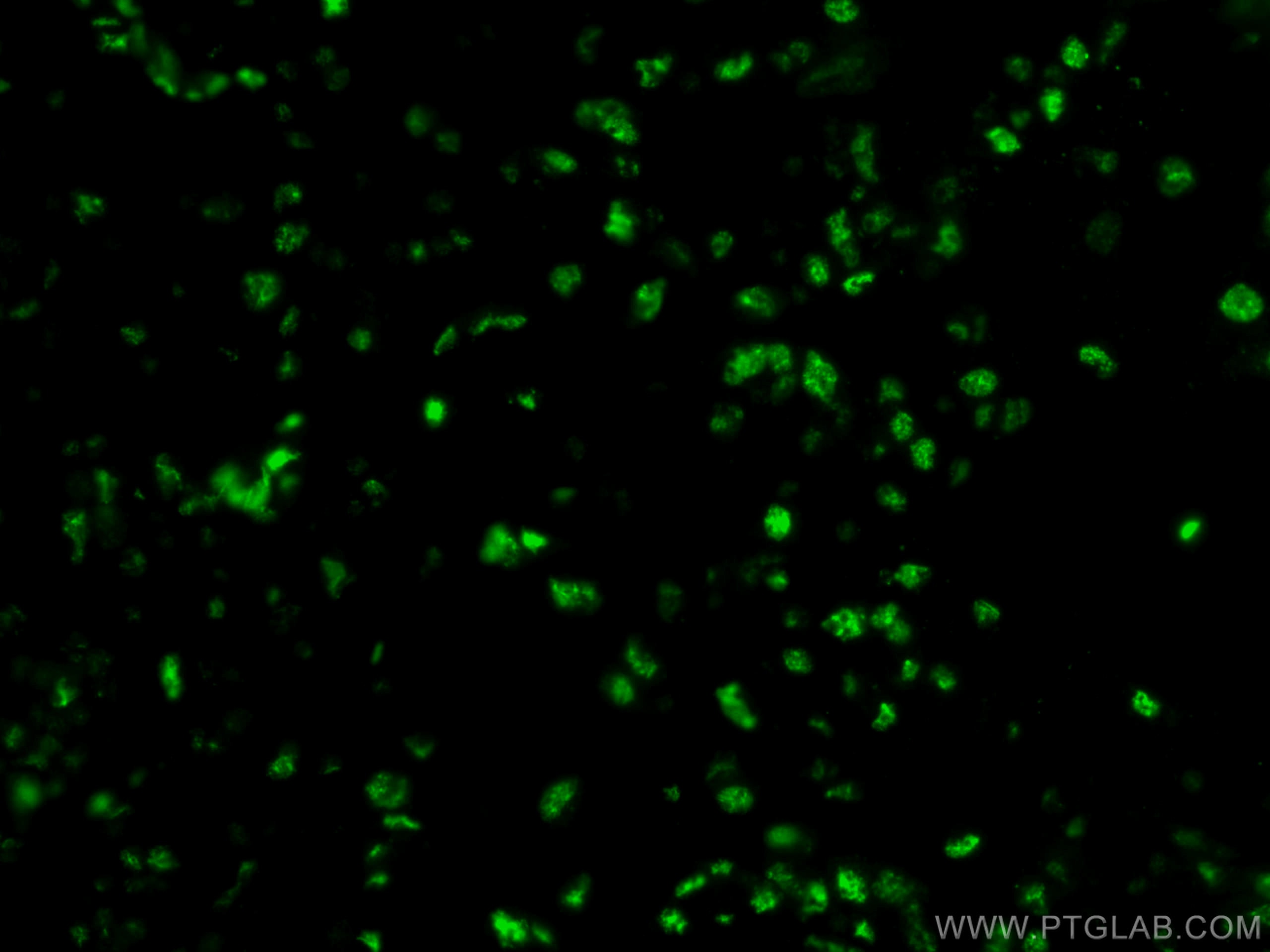 Immunofluorescence (IF) / fluorescent staining of human breast cancer tissue using HRPT2, CDC73 Monoclonal antibody (66490-1-Ig)