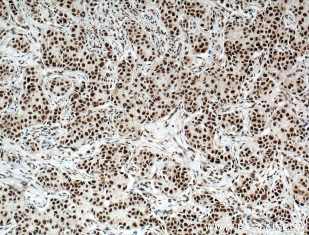 Immunohistochemistry (IHC) staining of human breast cancer tissue using HRPT2, CDC73 Monoclonal antibody (66490-1-Ig)