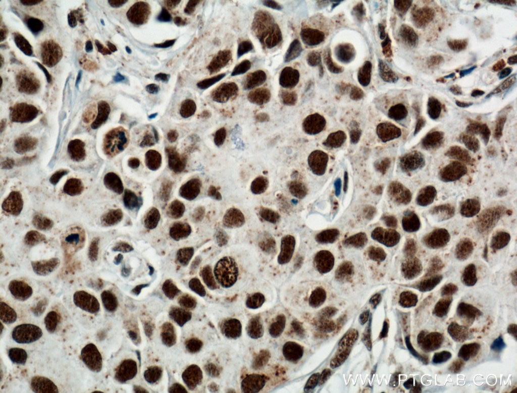Immunohistochemistry (IHC) staining of human breast cancer tissue using HRPT2, CDC73 Monoclonal antibody (66490-1-Ig)