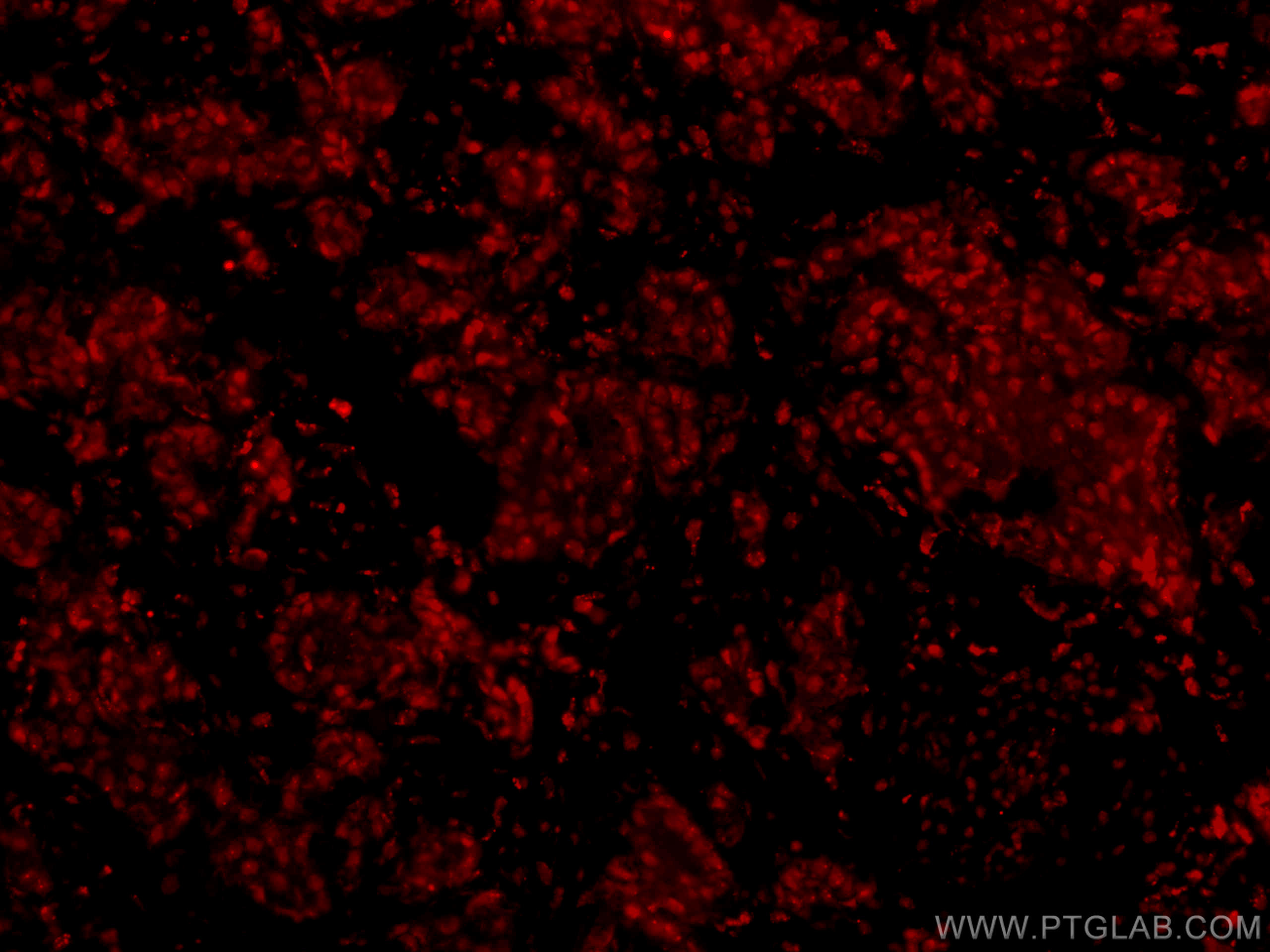 Immunofluorescence (IF) / fluorescent staining of human breast cancer tissue using CoraLite®594-conjugated HRPT2; CDC73 Monoclonal an (CL594-66490)