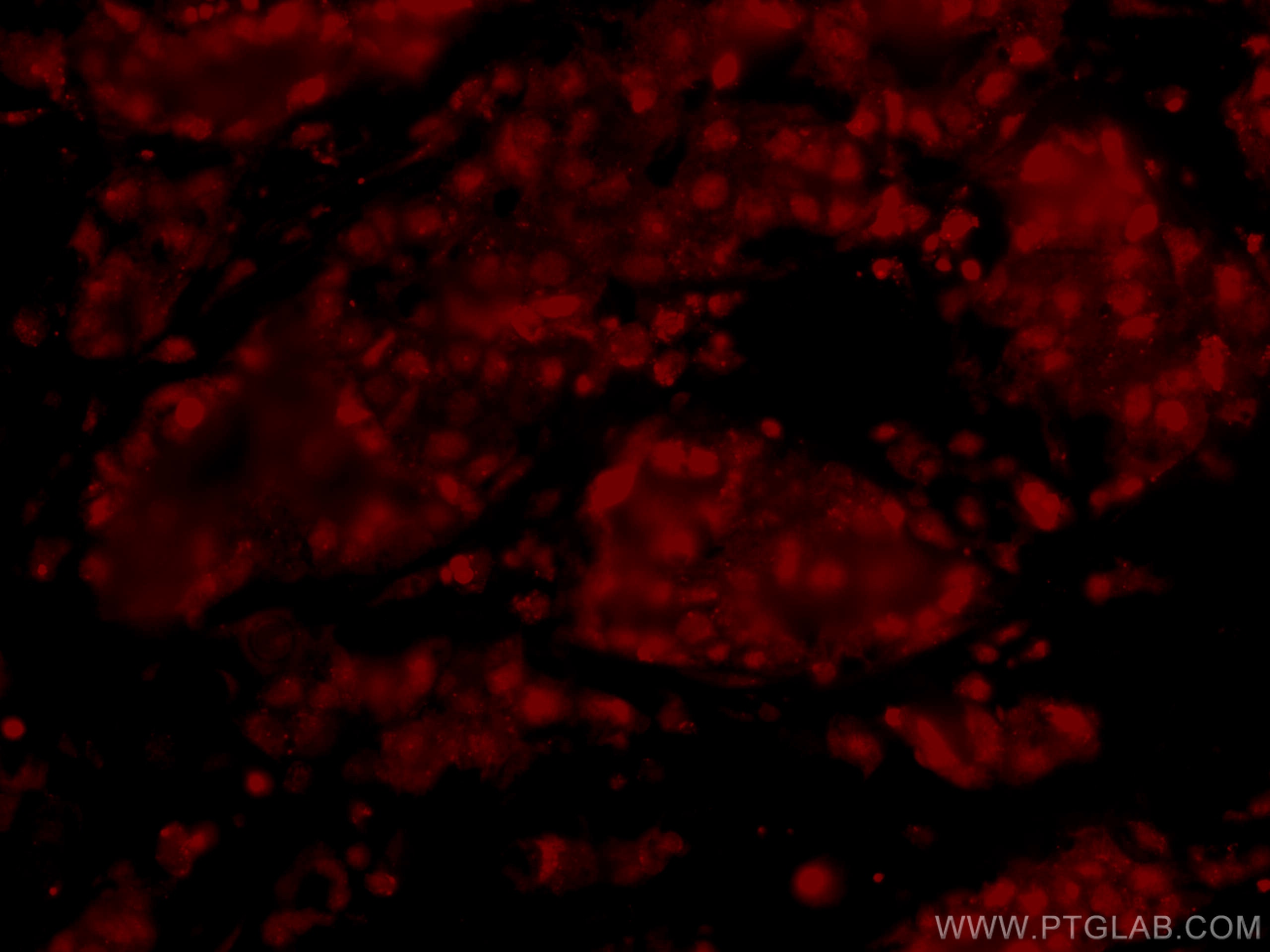 Immunofluorescence (IF) / fluorescent staining of human breast cancer tissue using CoraLite®594-conjugated HRPT2; CDC73 Monoclonal an (CL594-66490)