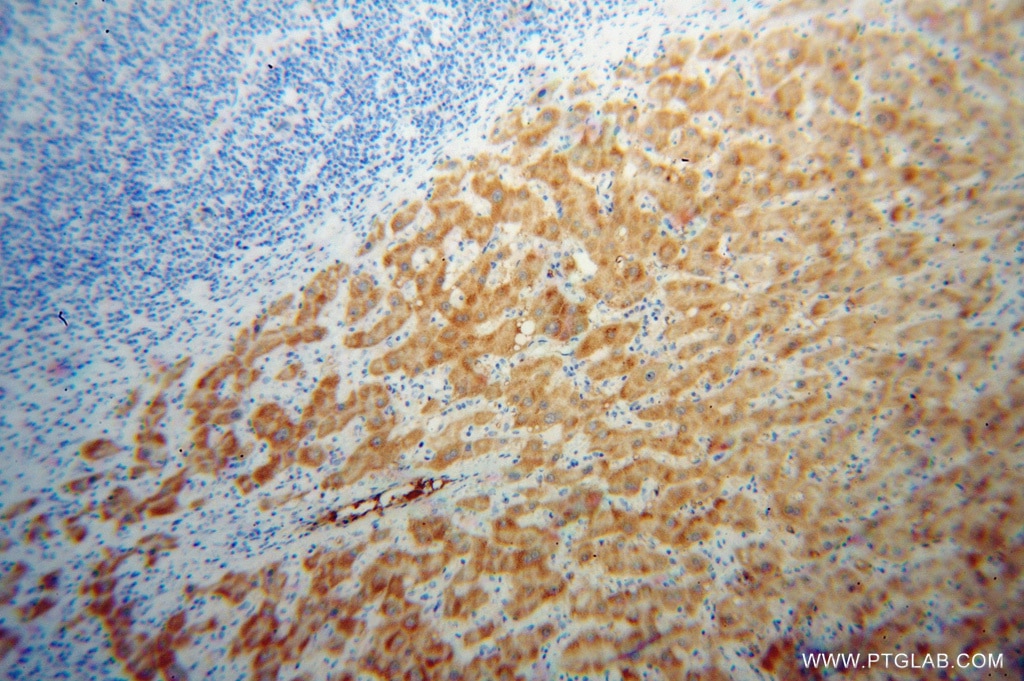 Immunohistochemistry (IHC) staining of human liver cancer tissue using HRSP12 Polyclonal antibody (12930-1-AP)