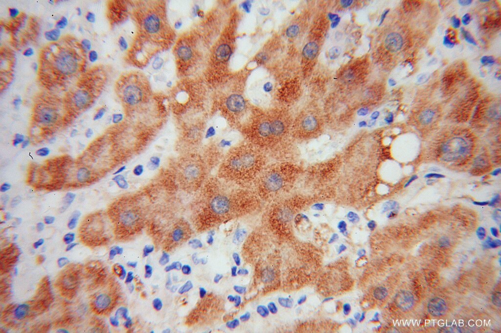 Immunohistochemistry (IHC) staining of human liver cancer tissue using HRSP12 Polyclonal antibody (12930-1-AP)