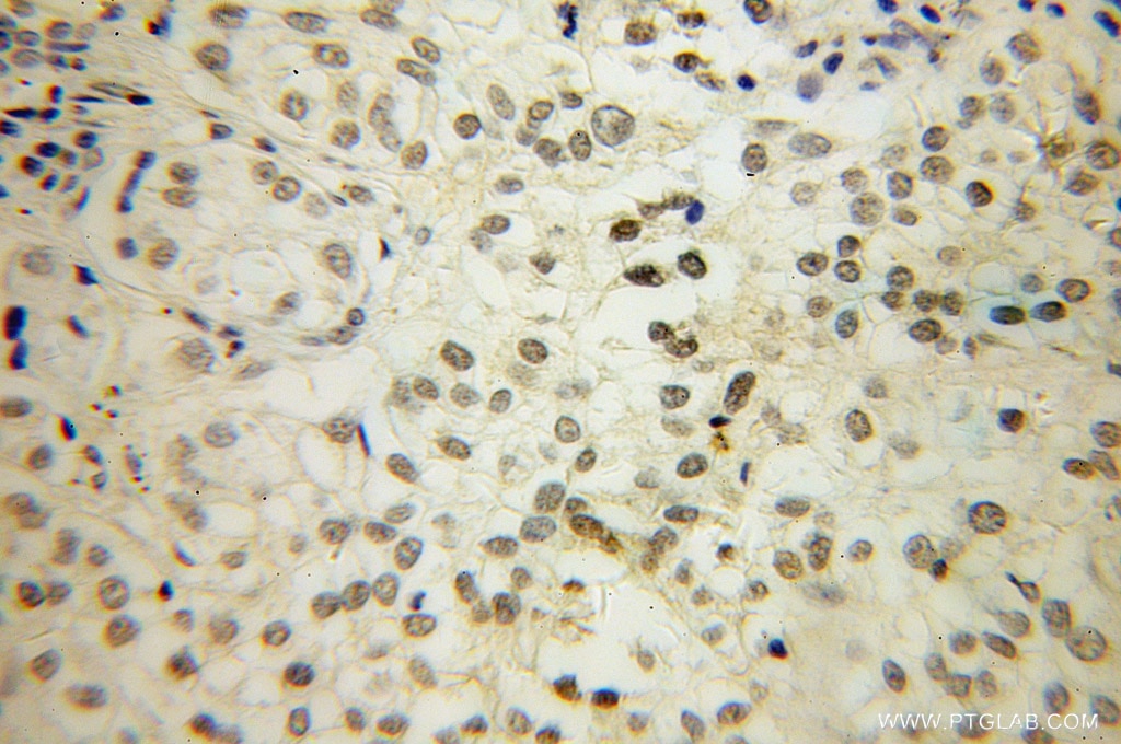 Immunohistochemistry (IHC) staining of human lung cancer tissue using HS1BP3 Polyclonal antibody (12845-1-AP)