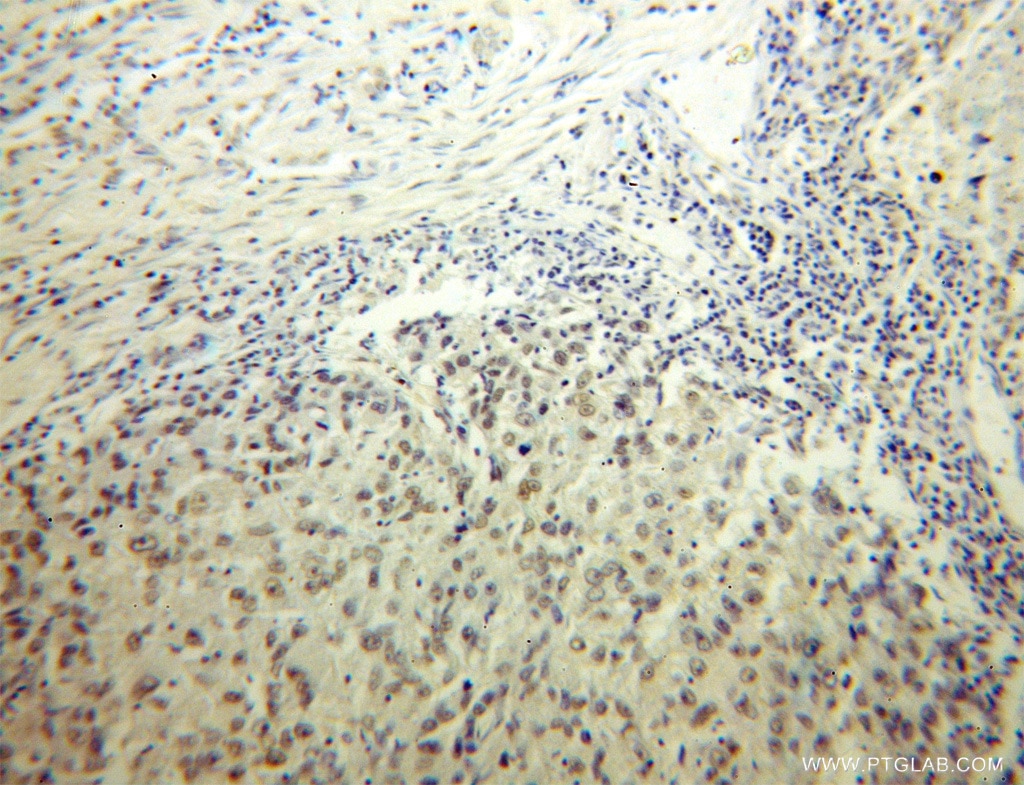 Immunohistochemistry (IHC) staining of human lung cancer tissue using HS1BP3 Polyclonal antibody (12845-1-AP)