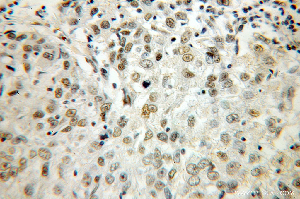 Immunohistochemistry (IHC) staining of human lung cancer tissue using HS1BP3 Polyclonal antibody (12845-1-AP)