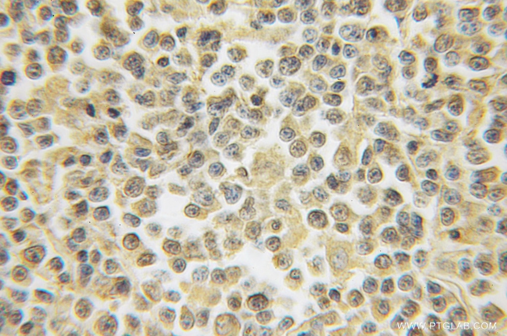 Immunohistochemistry (IHC) staining of human lymphoma tissue using HS2ST1 Polyclonal antibody (12453-1-AP)