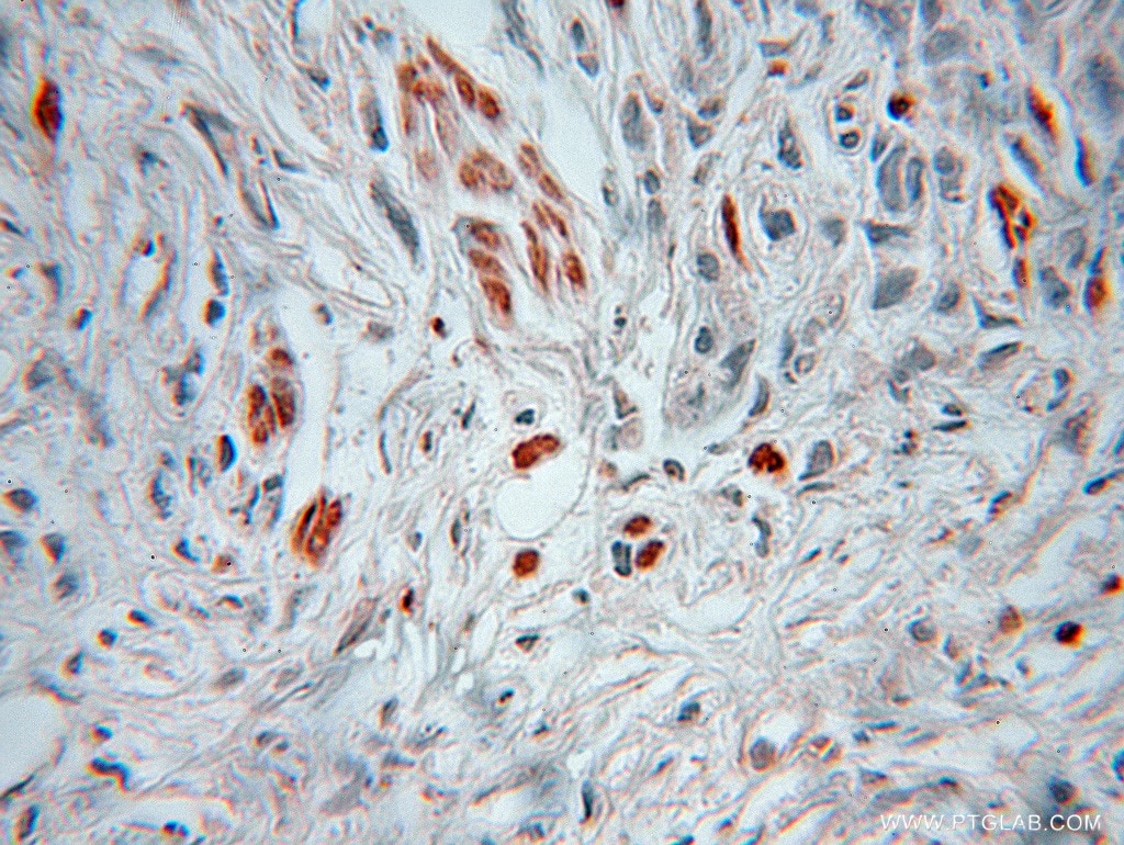Immunohistochemistry (IHC) staining of human prostate cancer tissue using HSBP1 Polyclonal antibody (10169-2-AP)