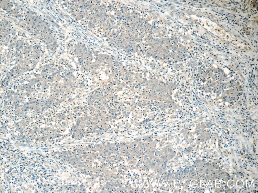 Immunohistochemistry (IHC) staining of human colon cancer tissue using HSCB Polyclonal antibody (15132-1-AP)