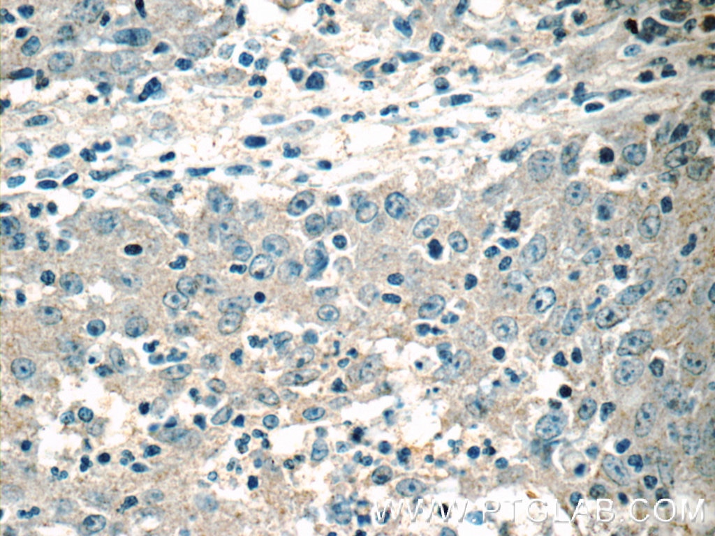 Immunohistochemistry (IHC) staining of human colon cancer tissue using HSCB Polyclonal antibody (15132-1-AP)