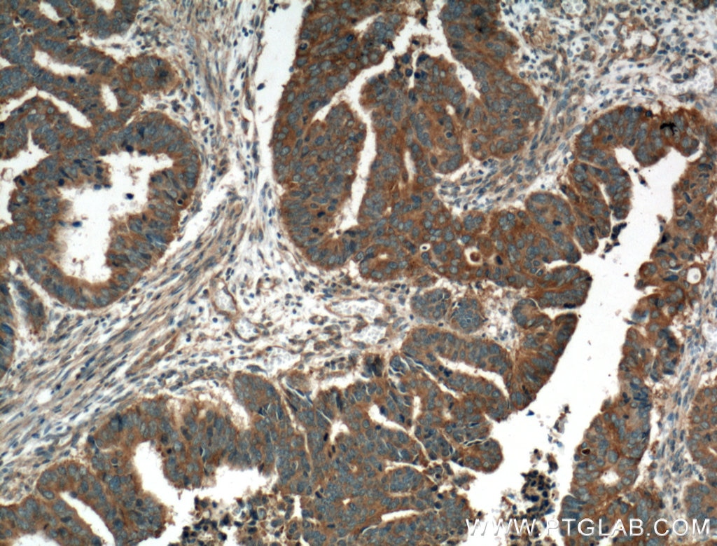 Immunohistochemistry (IHC) staining of human colon cancer tissue using HSD17B1 Polyclonal antibody (25334-1-AP)