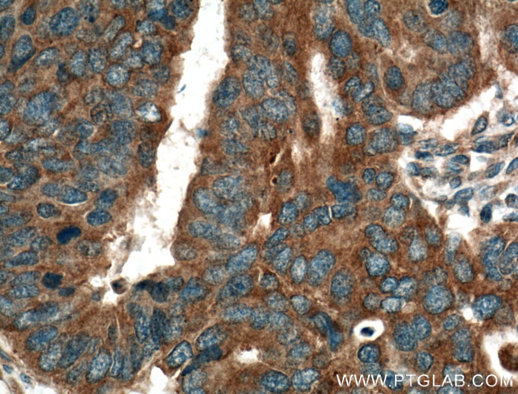 Immunohistochemistry (IHC) staining of human colon cancer tissue using HSD17B1 Polyclonal antibody (25334-1-AP)