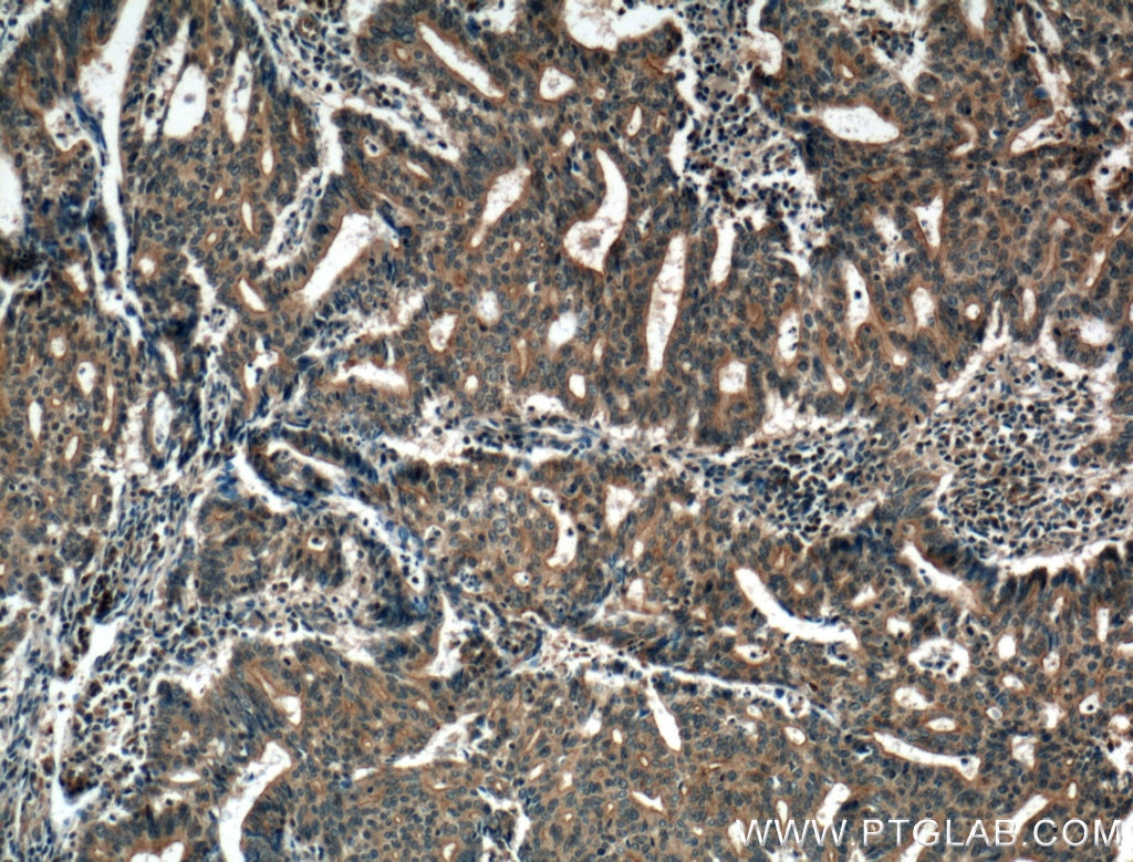 Immunohistochemistry (IHC) staining of human endometrial cancer tissue using HSD17B1 Polyclonal antibody (25334-1-AP)