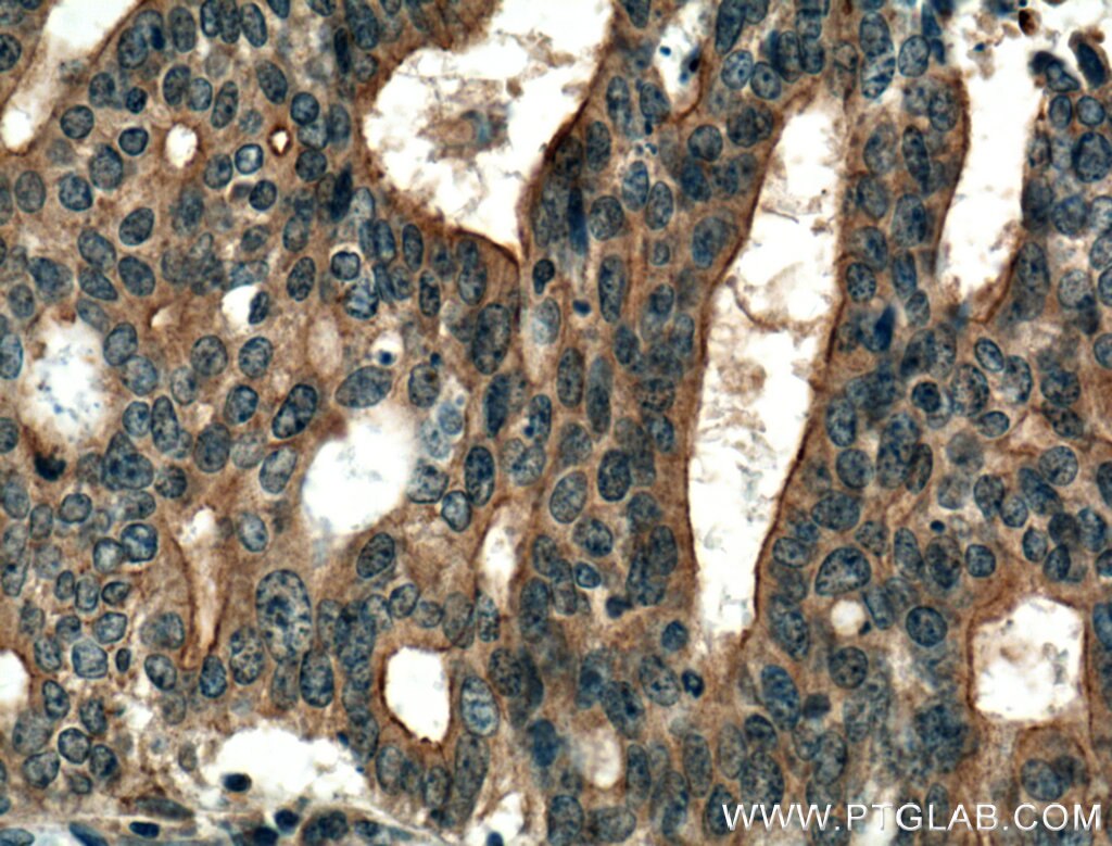 Immunohistochemistry (IHC) staining of human endometrial cancer tissue using HSD17B1 Polyclonal antibody (25334-1-AP)