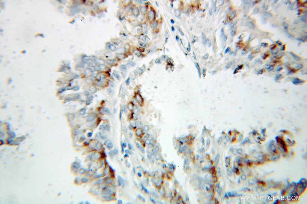 Immunohistochemistry (IHC) staining of human breast cancer tissue using ERAB Polyclonal antibody (10648-1-AP)