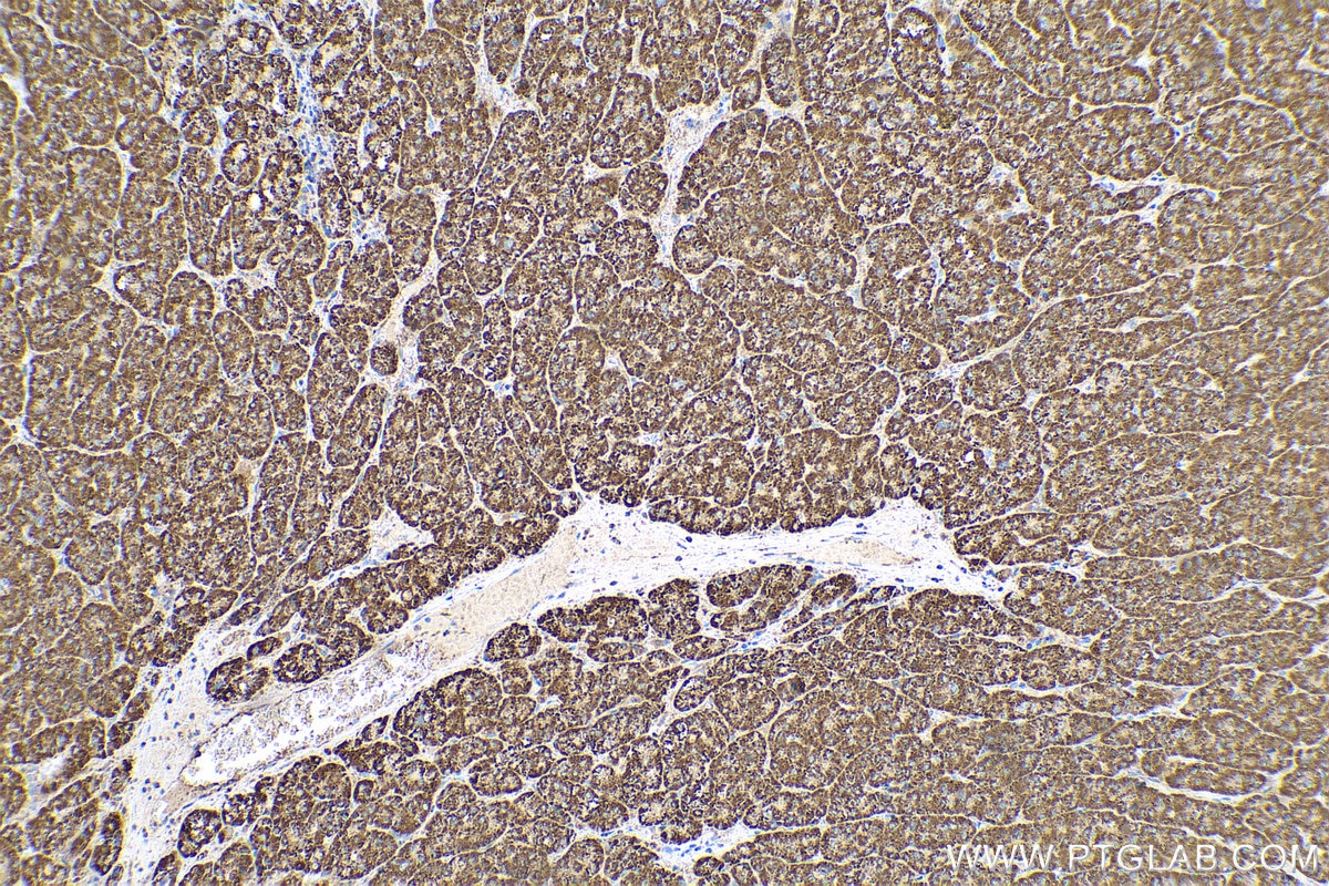 Immunohistochemistry (IHC) staining of human liver cancer tissue using ERAB Monoclonal antibody (60069-1-Ig)