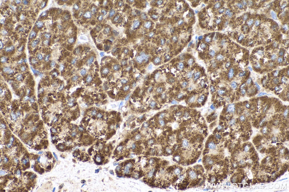 Immunohistochemistry (IHC) staining of human liver cancer tissue using ERAB Monoclonal antibody (60069-1-Ig)