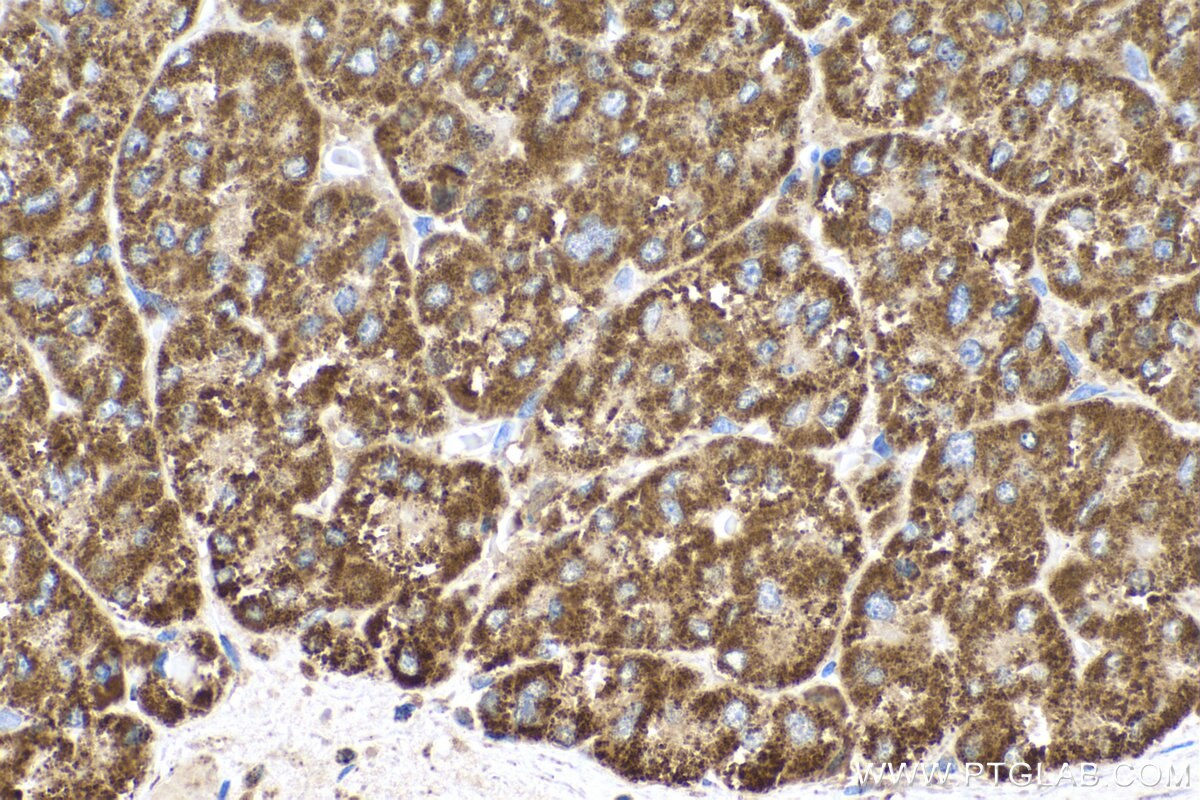 IHC staining of human liver cancer using 60069-1-Ig