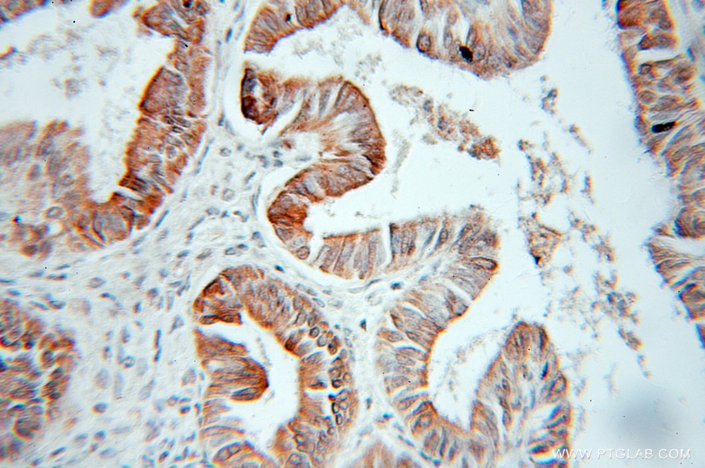 IHC staining of human ovary tumor using 10978-1-AP