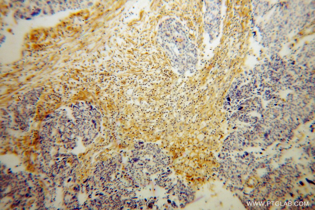 Immunohistochemistry (IHC) staining of human ovary tumor tissue using HSD17B2 Polyclonal antibody (10978-1-AP)