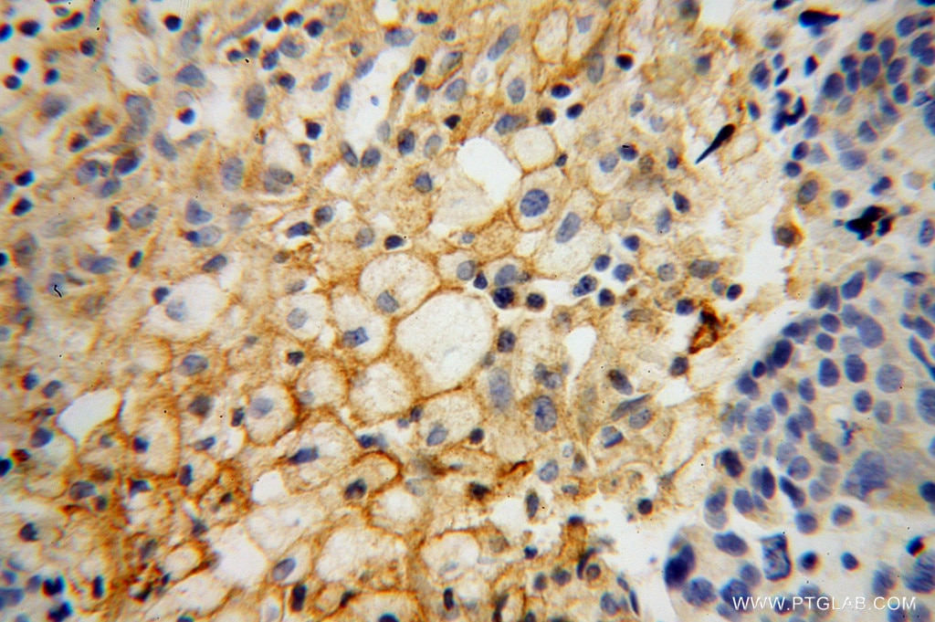 Immunohistochemistry (IHC) staining of human ovary tumor tissue using HSD17B2 Polyclonal antibody (10978-1-AP)