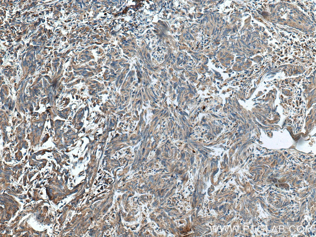 IHC staining of human prostate cancer using 15116-1-AP