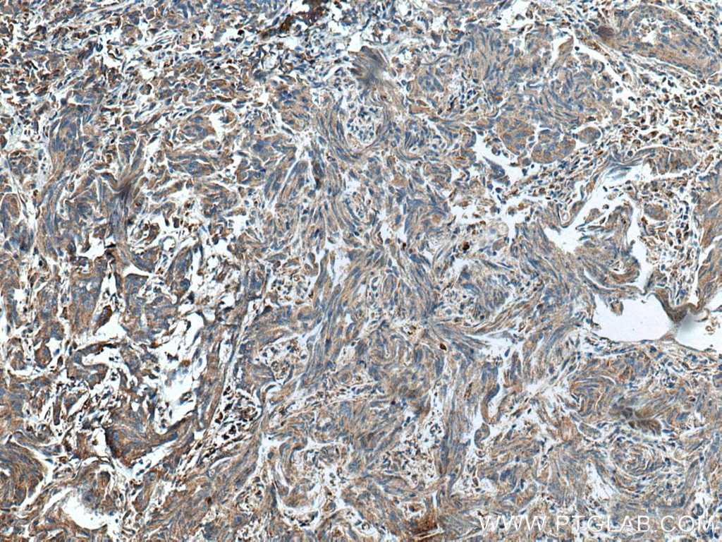 Immunohistochemistry (IHC) staining of human prostate cancer tissue using HSD17B4 Polyclonal antibody (15116-1-AP)