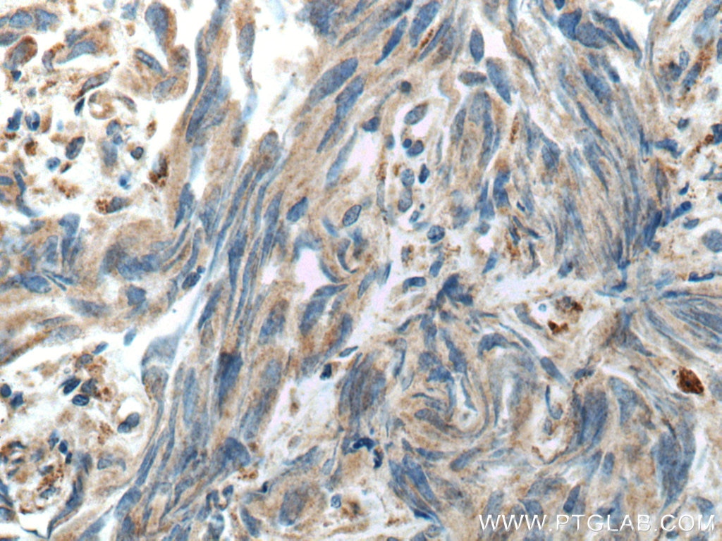 Immunohistochemistry (IHC) staining of human prostate cancer tissue using HSD17B4 Polyclonal antibody (15116-1-AP)
