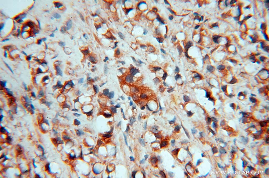 Immunohistochemistry (IHC) staining of human prostate cancer tissue using HSD17B4 Polyclonal antibody (15116-1-AP)